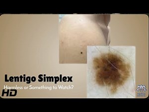 Lentigo Simplex: Causes, Symptoms, and Treatment Options