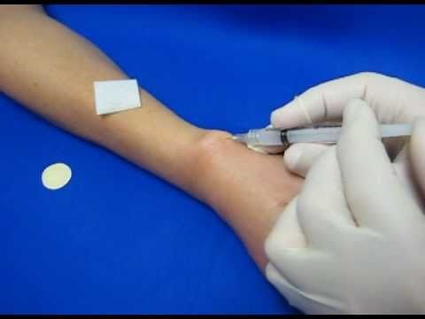 Hand Injection Techniques - De Quervain