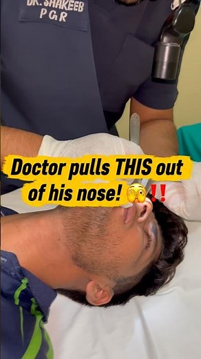 Post nasal surgery!! Splints removal #drshakeeb #entspecialist