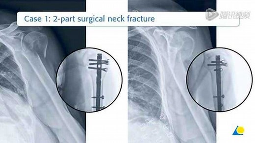 Multiloc肱骨髓内钉操作演示