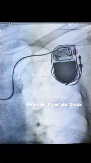 📌 Permanent Pacemaker (PPM) Implantation – Procedure #Pacemaker#HeartBlock #interventionalcardiology
