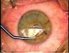 LASIK Enchancement - Lifiting the Flap - Eyetube