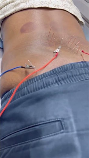 Acupuncture Treatment for Back Pain & Neck Pain | Natural Pain Relief Therapy