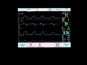 NAVA Brief description