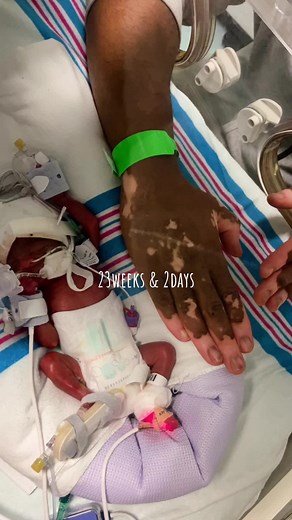 Meet Legacy. He is a preemie born at 23 weeks and 2 days. Follow us as we share his journey. #preemie #pregnancy #prematurebaby #prematuro #prematurebirth #prematurelabour #neonatal #survivor #babytok #MiracleBaby #myson #kidsontiktok #JustABaby