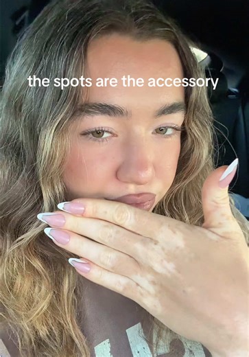 always got the spotties on me :) #vitiligo #vitiligobeauty #vitiligoconfidence