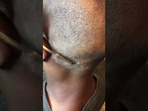 Dandruff After A Fresh Haircut