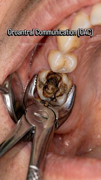 🚨 The Sinus Void: Managing Oroantral Communication (OAC)