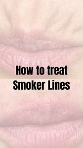 Smoker lines are vertical wrinkles that develop around the mouth and upper lip, often called “lipstick lines” or “perioral lines”. While they are common in smokers, they also appear in non-smokers due to other factors like aging, sun exposure, genetics, and repetitive muscle movements, such as puckering the lips. These lines can make lips look thin and aged. We can treat these lines to soften them without the use of filler! #aesthetics #smokerlines #antiwrinkle #skincare #trendingreels #antiwrin