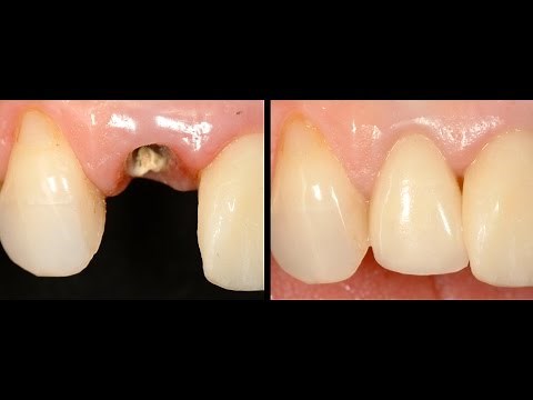 Ferrule Effect - A different point of view of the preparation of endodontically treated teeth.