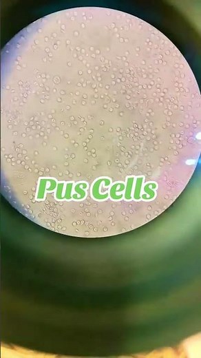 Urine analysis in microscopy 🔬 #urinalysis #microscopy