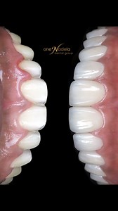 Emax Porcelain Veneers: Where Beauty Meets Strength! 🦷💎 Proud to be part of @jenelayam ‘s smile journey with her new set of Emax Porcelain! ✨ With their ultra-thin design and long-lasting durability, they’re the perfect choice for a flawless smile. 😃 Ready for your transformation? Book today! 📞 #EmaxVeneers #SmileGoals #NaturalSmile #OneNadela #OneNadelaDental #PerfectSmile #ConfidentYou #DentalTransformation | One Nadela Dental Group