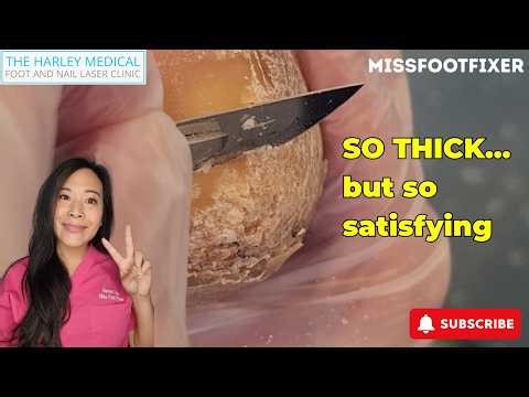 Satisfying Callus Removal You Can’t Look Away From | Part 1 by Miss Foot Fixer Marion Yau