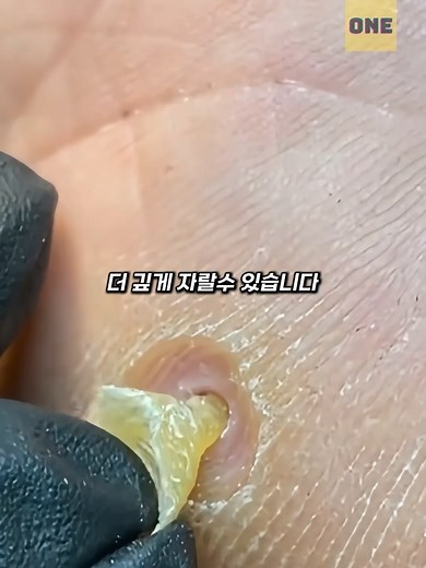 티눈 제거 시 주의해야 할 점