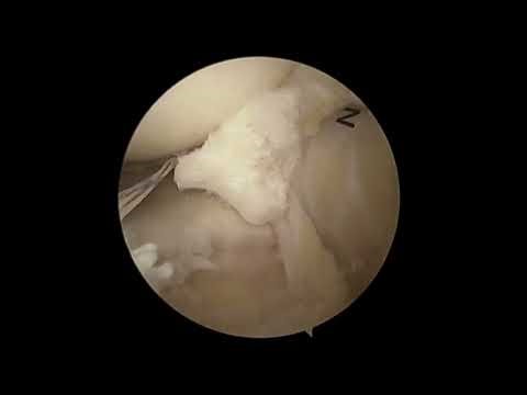 Dr. Garcia’s – Anterior Meniscal Root Repair Technique