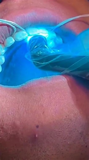 POV: Braces Off? Lock Your Smile Forever with a Fixed Retainer | Santa Teresa Dental Center CA, USA!