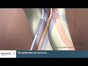 Outside U.S. only WavelinQ™ 4F EndoAVF System Procedural Animation (No Audio)