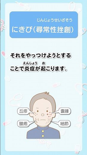 にきびが何かを30秒で解説！