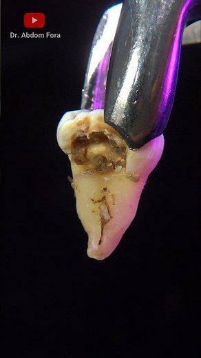 Extracción dental paso a paso #dentist