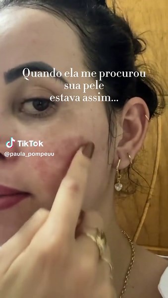 Recuperação de Pele Após Peeling de ATA CROTON