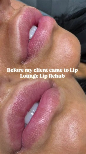 Lip Rehab Solutions for Overfilled Lips