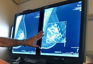 MammoScreen: AI technology aids in detecting breast cancer two years earlier