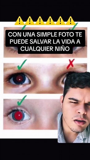 Retinoblastoma: Síntomas y Detección Temprana en Niños