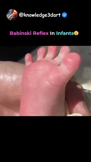 👣 Babinski Reflex in Infants Explained When the sole of a baby’s foot is gently stroked, their big toe bends upward and the other toes fan out — this is called the Babinski reflex. 🍼 ✅ Importance: Normal in newborns up to ~12–24 months. Shows healthy development of the nervous system. Disappearing as the brain and spinal cord mature. If it persists beyond 2 years, it may indicate a neurological issue. 🔍 Pediatricians use this reflex to check proper brain and spinal cord function in infants. |