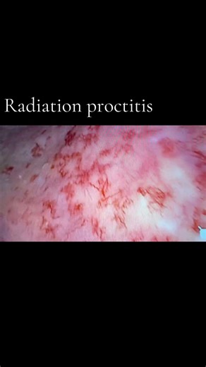 Radiation Proctitis Explained: Why Rectal Bleeding Happens After Prostate Radiation #GIHealth