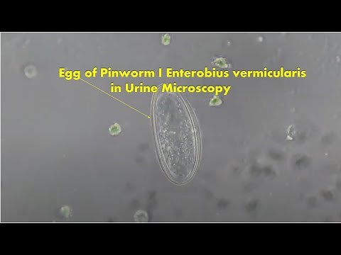 Egg of Pinworm in Urine Microscopy |Enterobius vermicularis