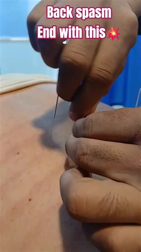 Severe Back Spasm? Try Dry Needling💥😱#painrehabb#backpainrelief#physiotherapy #backpain#viral#shorts