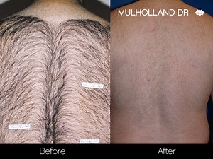 New Laser Hair Removal Technology Makes Total Body Hair Removal Possible in Just 30 Minutes