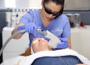 IPL Photofacial - Clearstone Laser Hair Removal & Med Spa
