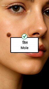 Acne, Mole, Wart English Names.🔥 Related to skin English Vocabulary #mole #acne #englishlearning #English #freckles #RINGWORM #vocabulary #facebookviral | English Speaking