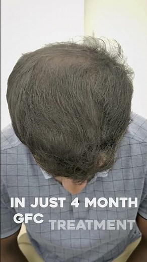 Real GFC Hair Growth Transformation 🤯🔥