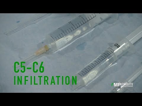 C5-C6 infiltration