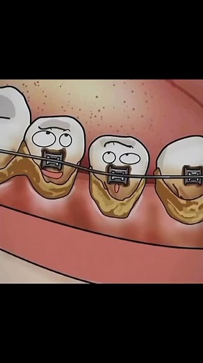 19K views · 27 reactions | Scaling and polishing is a procedure that removes dental plaque, tartar and extrinsic stains that are present on the outer surface of the teeth. Scaling and polishing cleans your teeth, preventing and controlling the severity of gum diseases. By | Dentistry blog | Facebook