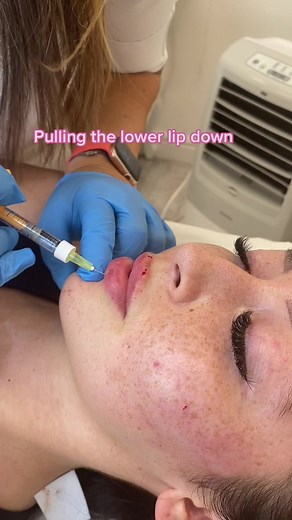 Learn advanced lip filler techniques with us in our 5* rated academy located in 📍Accrington. #lipfillers ##lipfilleracademy #aestheticsclinic
