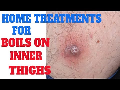 Home remedies to get rid of boils on inner thighs | treatments for boils on skin | boils on buttocks