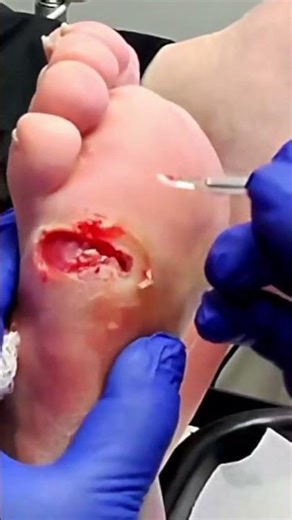 Wound Care Tips for At-Home Treatment 🩹👣