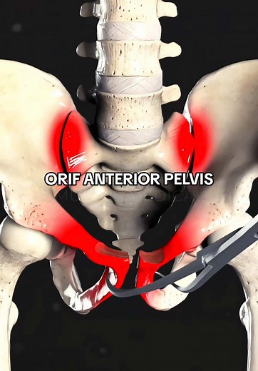 Pelvic Injury Insights: Catastrophic Trauma Analysis