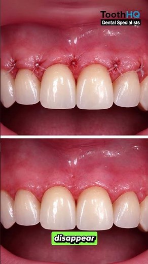 How long does it take for gums to heal after crown lengthening?