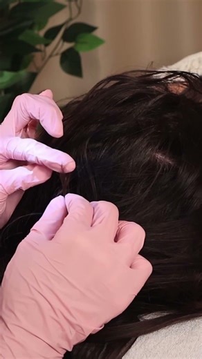 Ultimate ASMR Exam of RED SPOTS on SCALP with Treatment #asmr #short #shorts