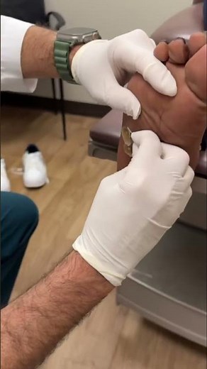 Removing a CLOGGED SWEAT GLAND!!🤯
