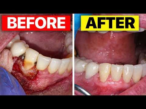 I SAVED A Tooth From DISSOLVING With A Filling, Gum Surgery, & Root Canal - External Resorption