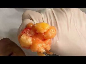 Fast and Safe Lipoma Removal Surgery with Dr. Shafa - OC Mederm /Irvineskin