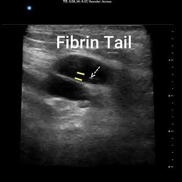 Midline, Re-establishing Blood Return
