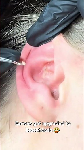 Earwax got upgraded to blackheads😂