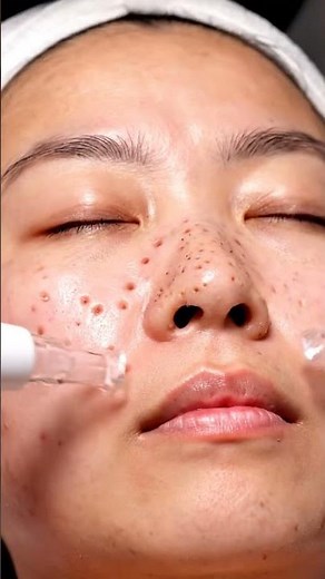 “Relaxing Full Face Blackhead Vacuum ASMR (No Talking)”