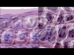Progression of Conjunctival Intraepithelial Neoplasia